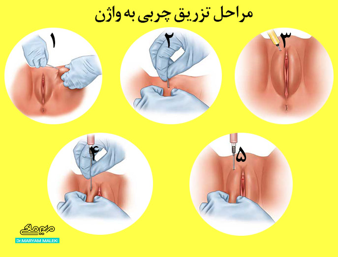 مراحل تزریق چربی به واژن