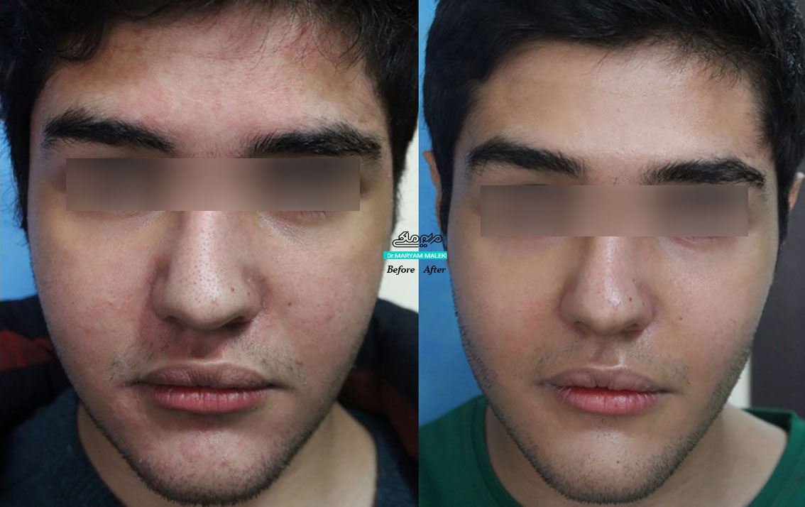 درمان سبوره-و-لیزرتراپی