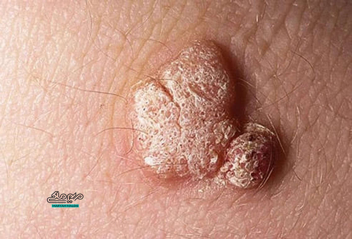 زگیل-تناسلی-تشخیص-و-درمان