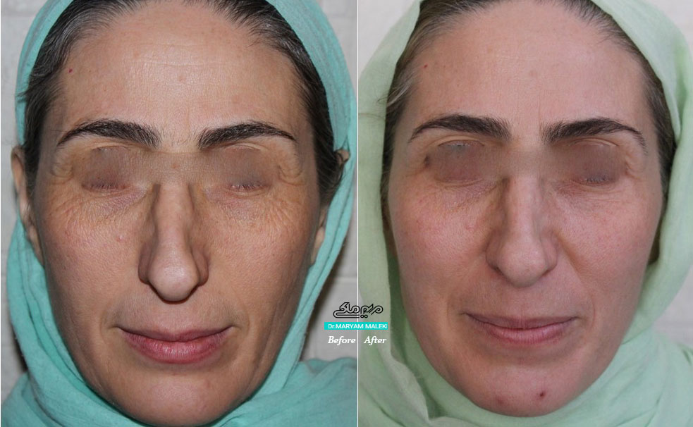 جوانسازی بعد از یک جلسه تیکسل و تزریق-بوتاکس