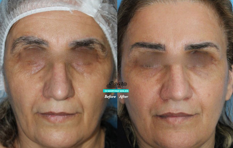 جوانسازی تزریق-چربی