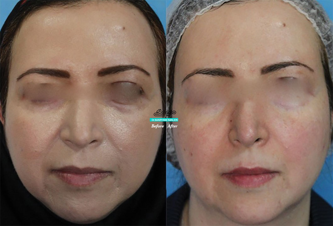 جوانسازی-با-هایفوتراپی