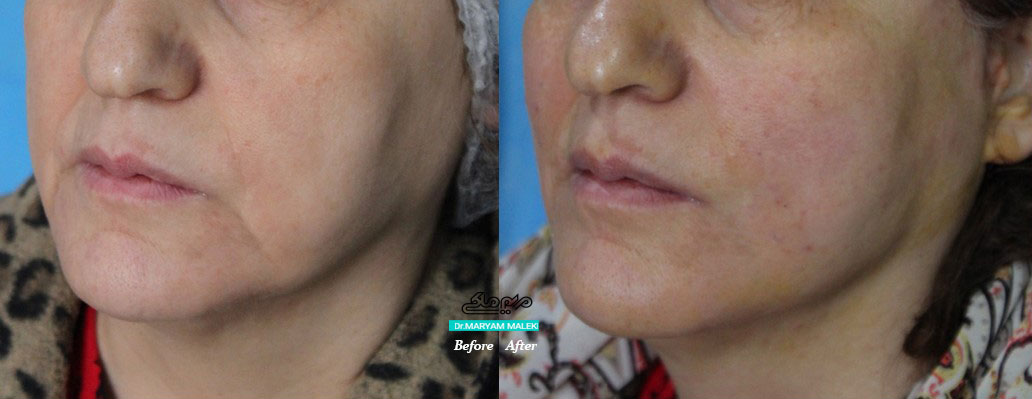 رفع-افتادگی-و-شلی-پوست-با-نخ