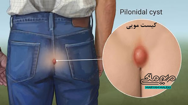 کیست-مویی،-کیست-پیلونیدال