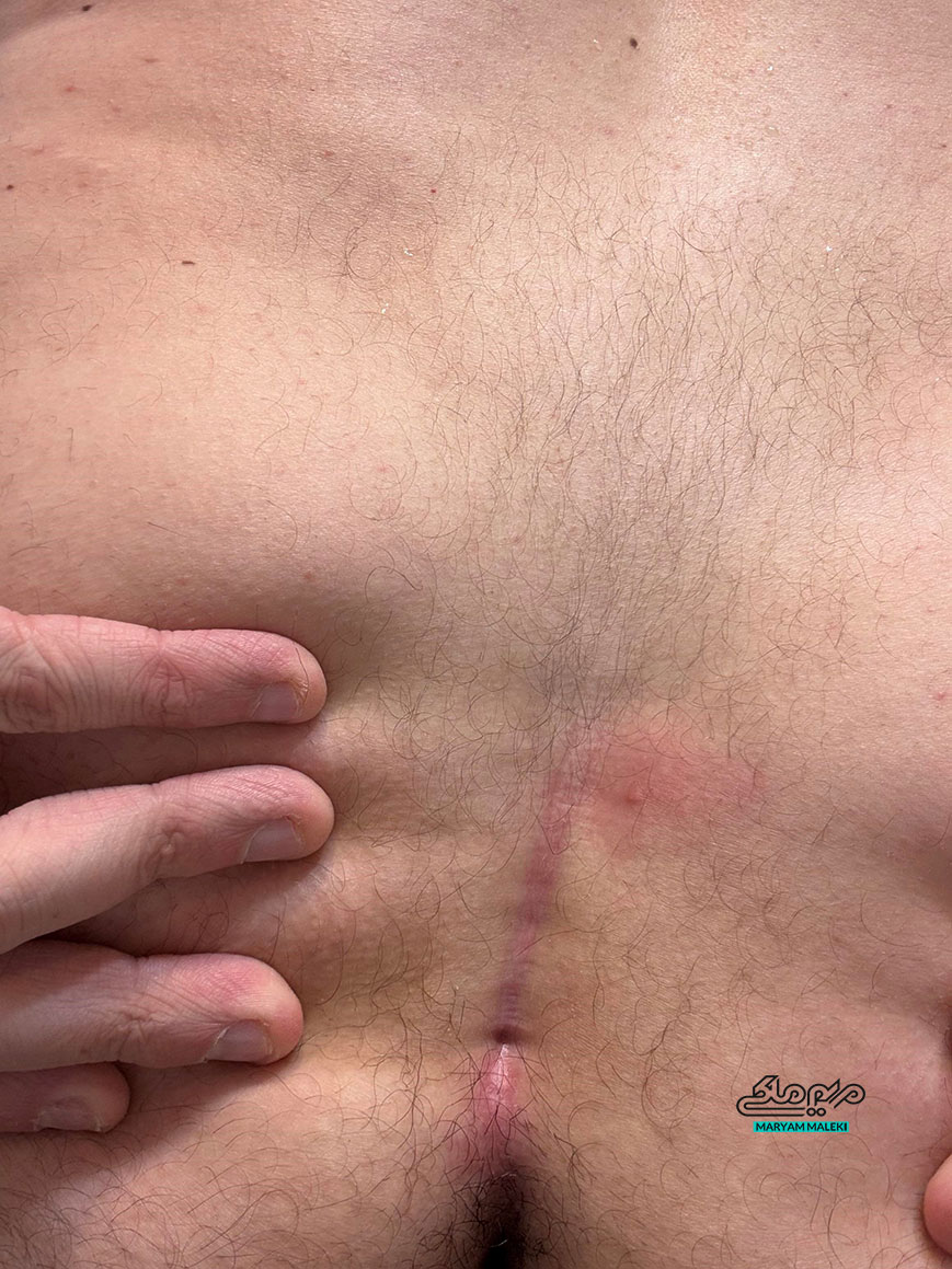 کیست-پیلونیدال-یا-مویی