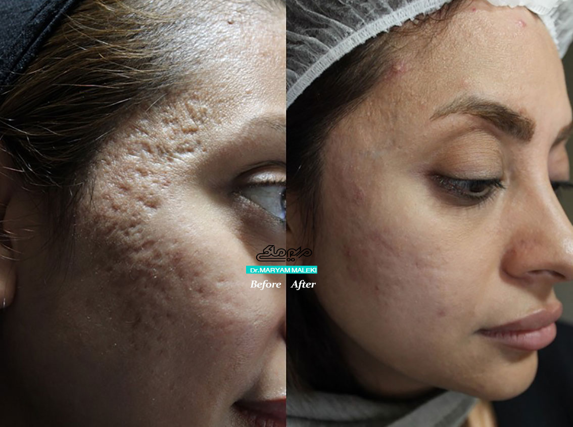 اسکار درمان