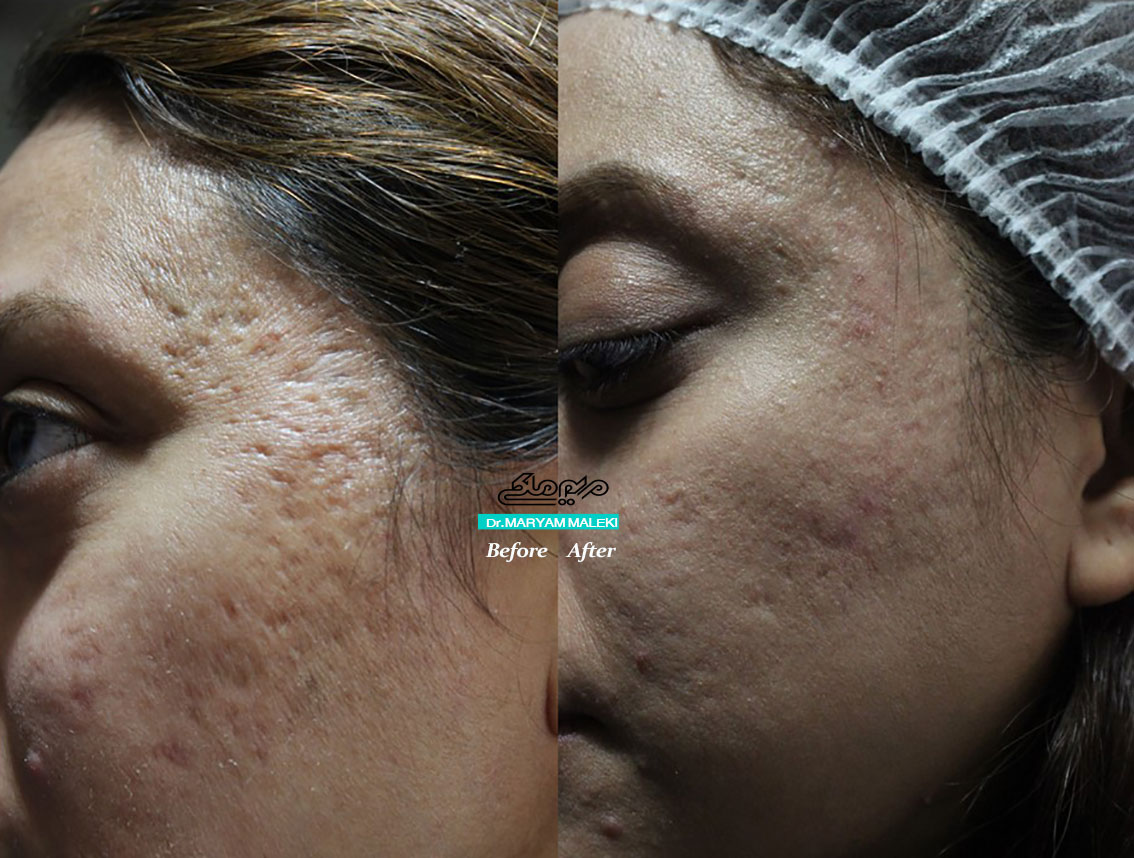 درمان اسکار با لیزر