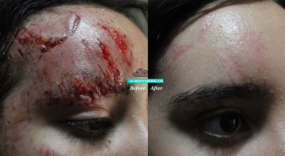 اسکار بعد از تصادف