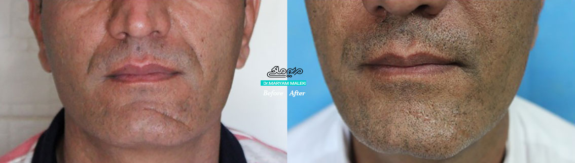 ماندگاری فیلر الانسه