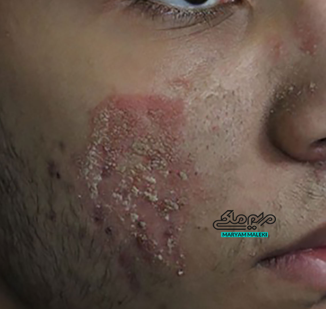 درماتیت-سبوره-یا-شوره-ای