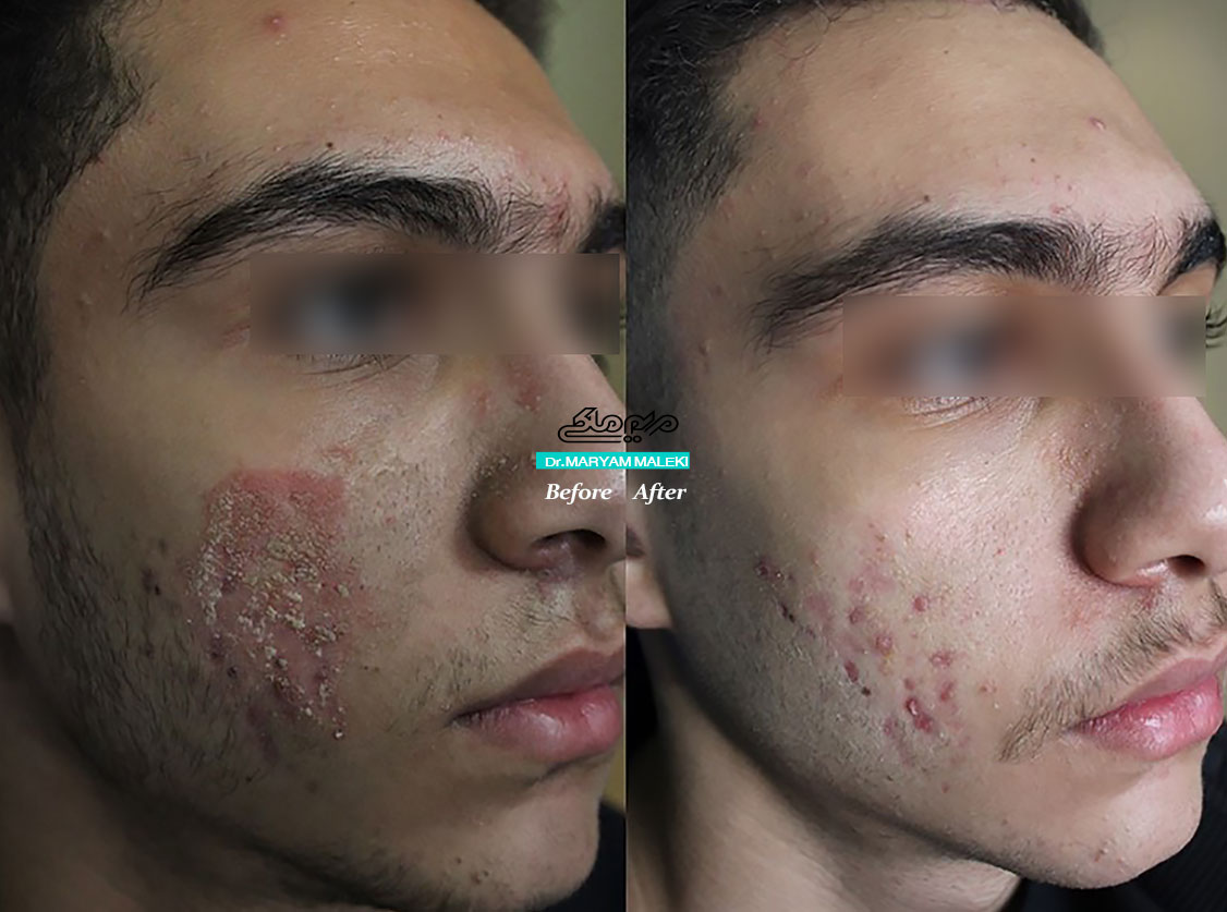 درمان-درماتیت-سبوره با لیزرتراپی