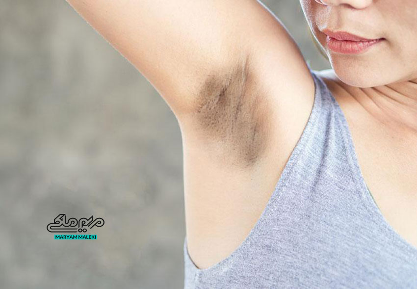 تیرگی-زیر-بغل