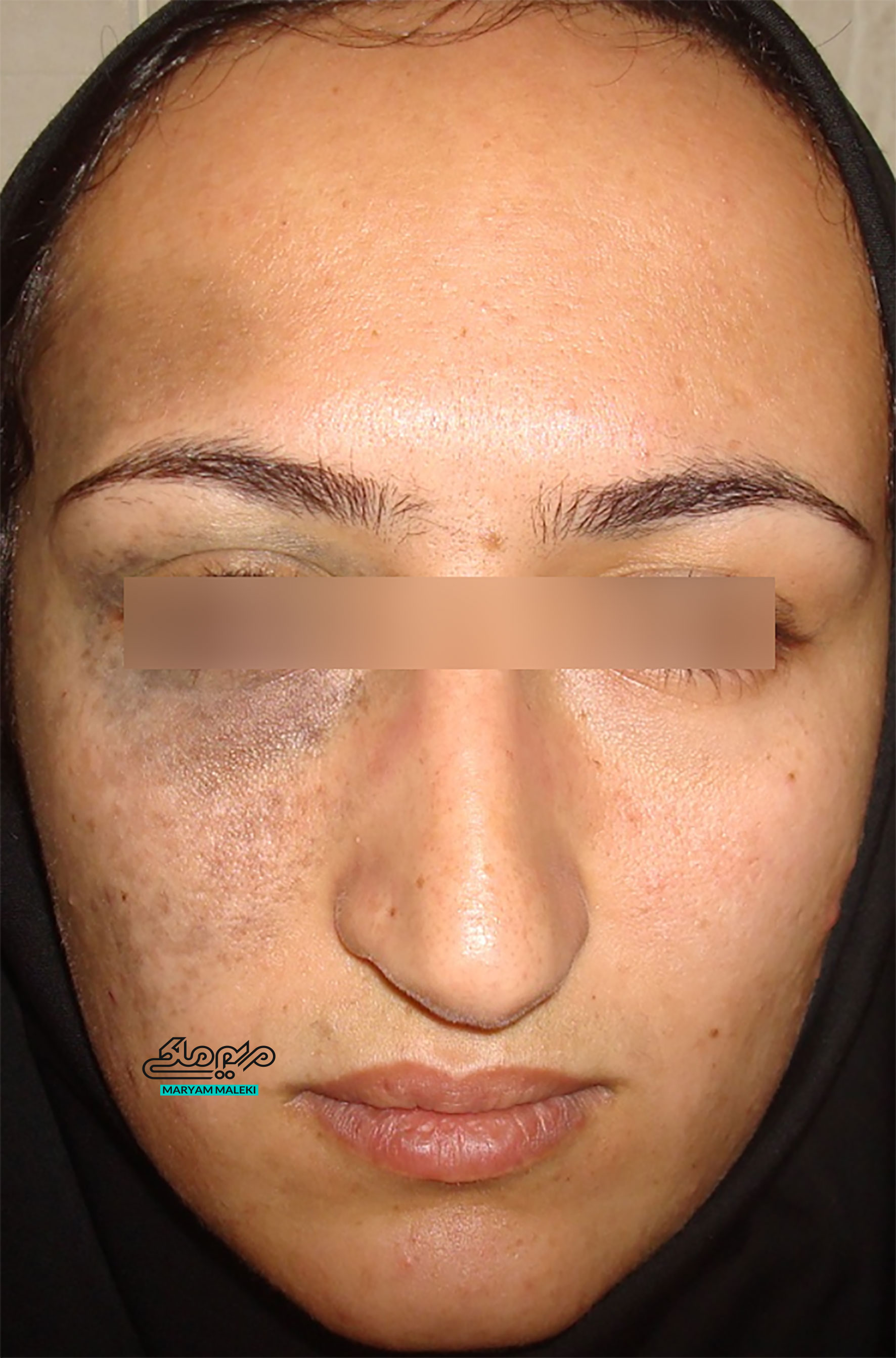 لک و خال مادرزادی اوتا