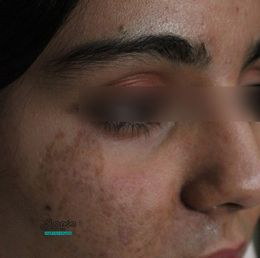 خال اسپایلوس