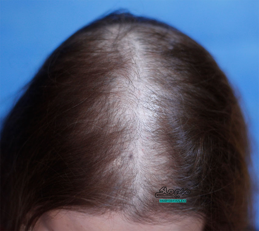 علل ریزش موی زنان