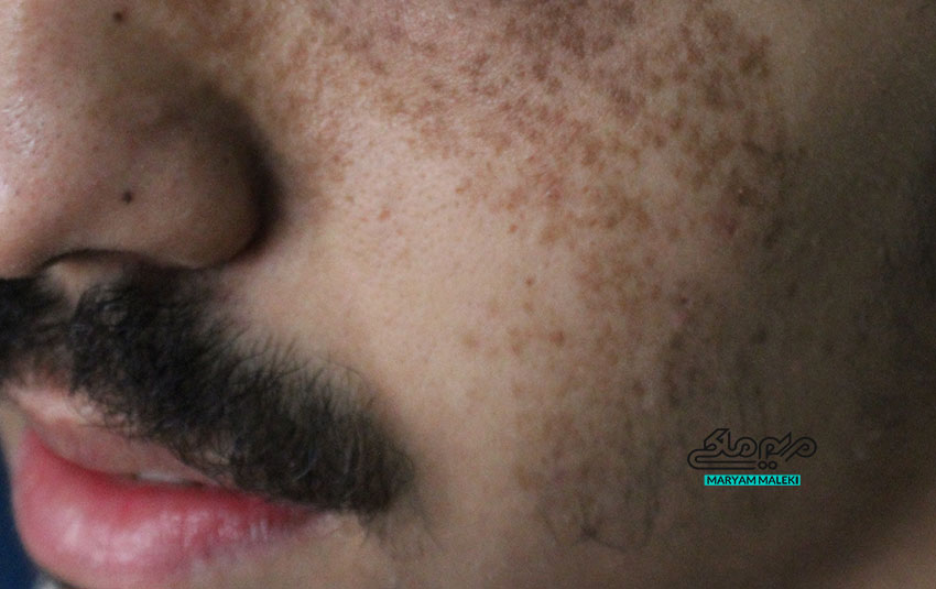 لک مادرزادی