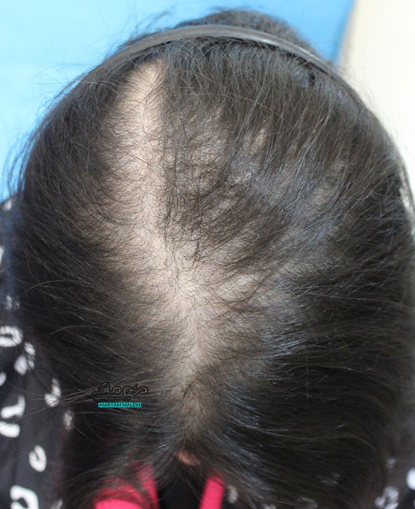 علل ریزش مو