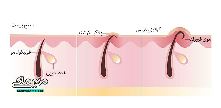 ایجاد-پوست-مرغی