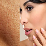 علل و درمان منافذ باز پوست (پوست پرتقالی)