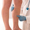 درمان واریس  پا و مویرگهای صورت با لیزر