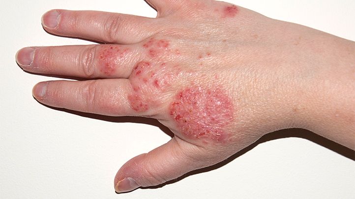 what-is-eczema-