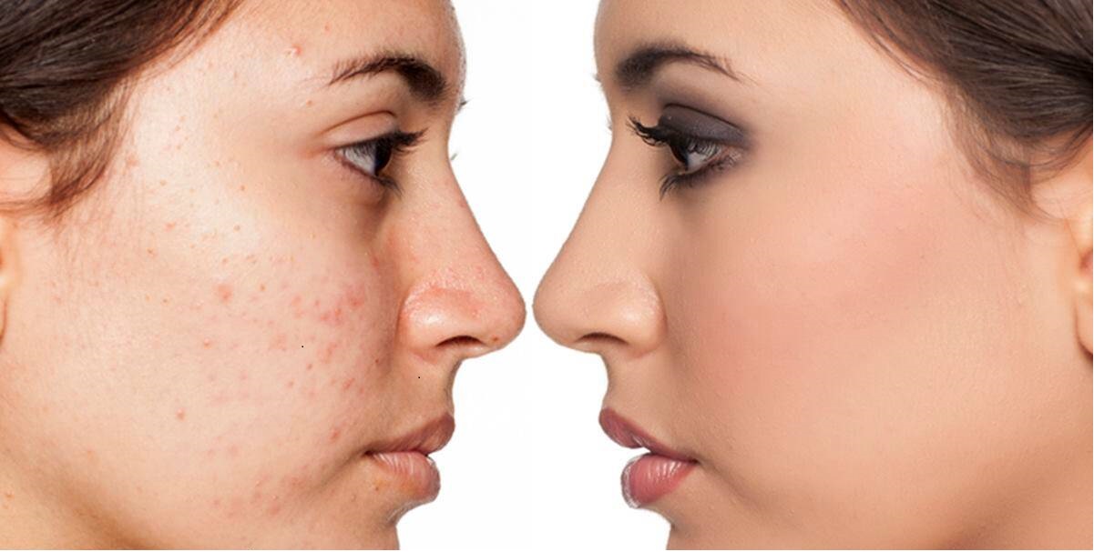 GettyImages-acne-skincare-1200