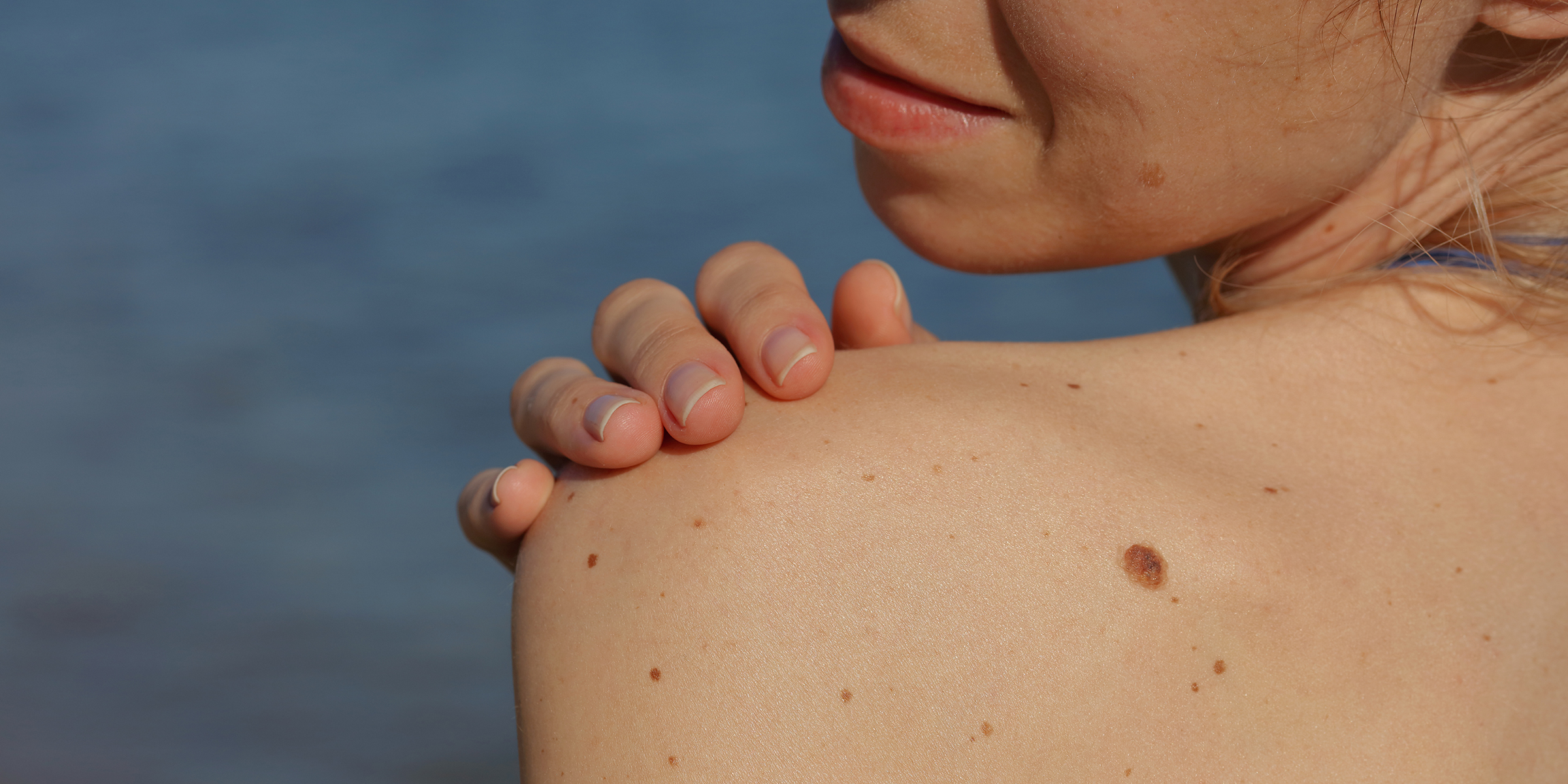 Checking benign moles : Beautiful Woman with birthmarks on her back and face. Laser skin tags removal