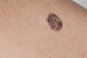 سرطان سلول سنگفرشی پوست چیست؟