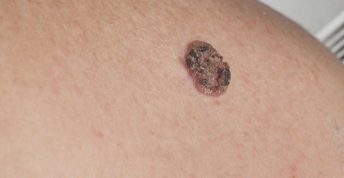 سرطان سلول سنگفرشی پوست چیست؟