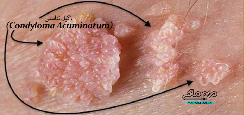 زگیل-تناسلی-(Condyloma-Acuminatum)