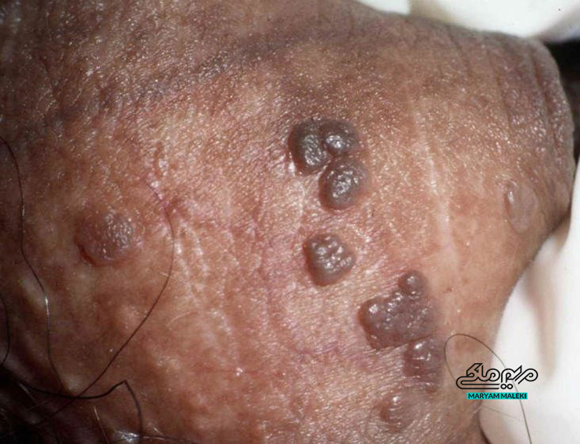 پاپولوزیس-بونوئید--(Bowenoid-Papulosis)