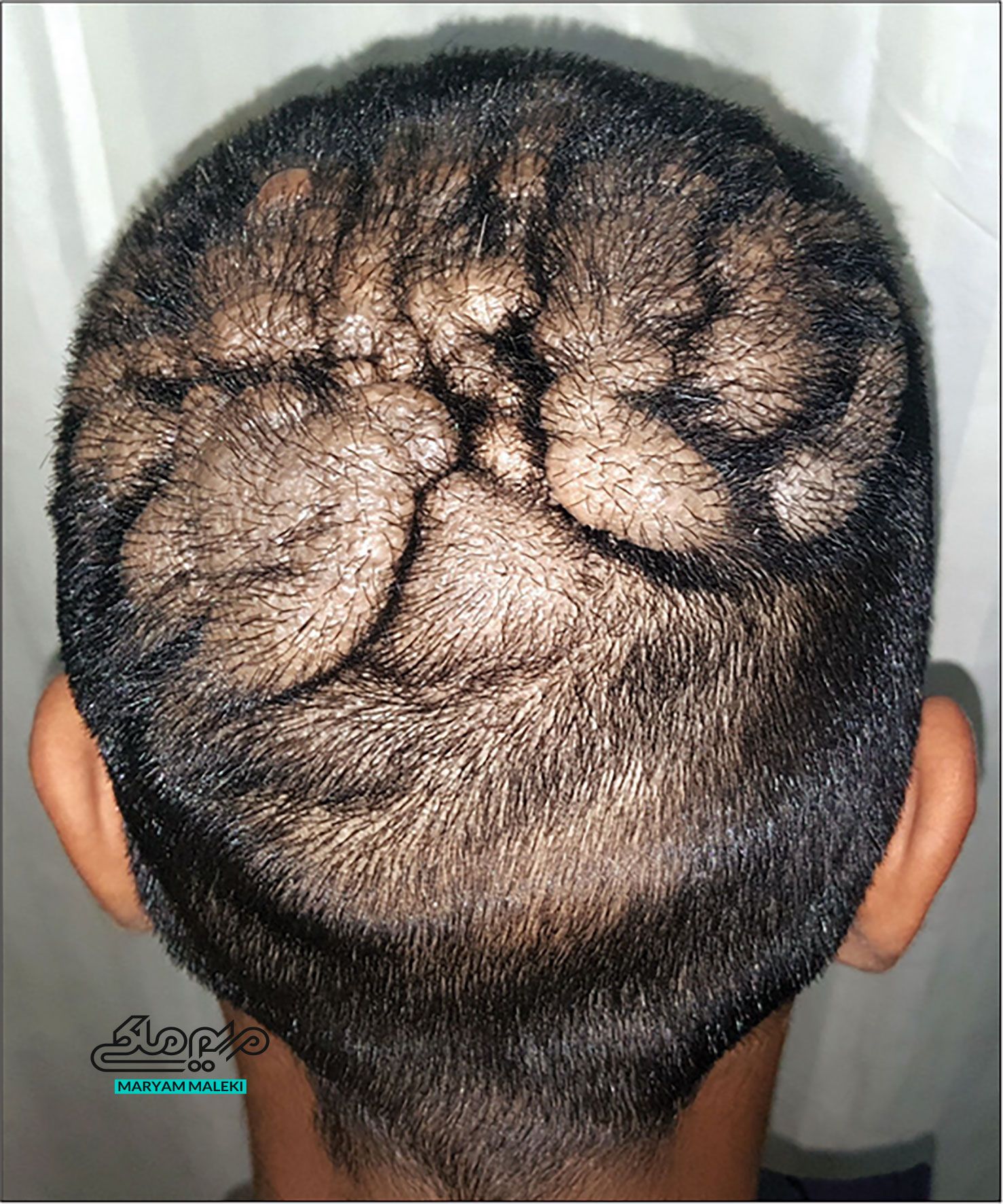 آشنایی با  بیماری نادر پوستی کوتیس ورتیس ژیراتا (Cutis Verticis Gyrata)