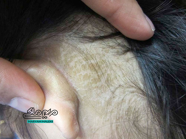 بیماری- پوستی- Terra-Firma-Forme-Dermatosis