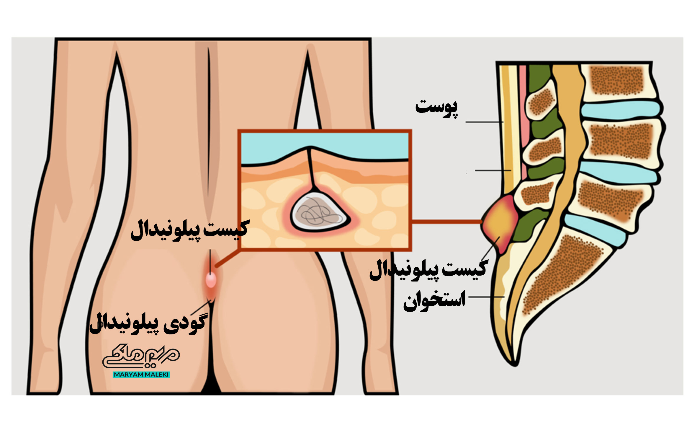 کیست پیلونیدال )کیست مویی(