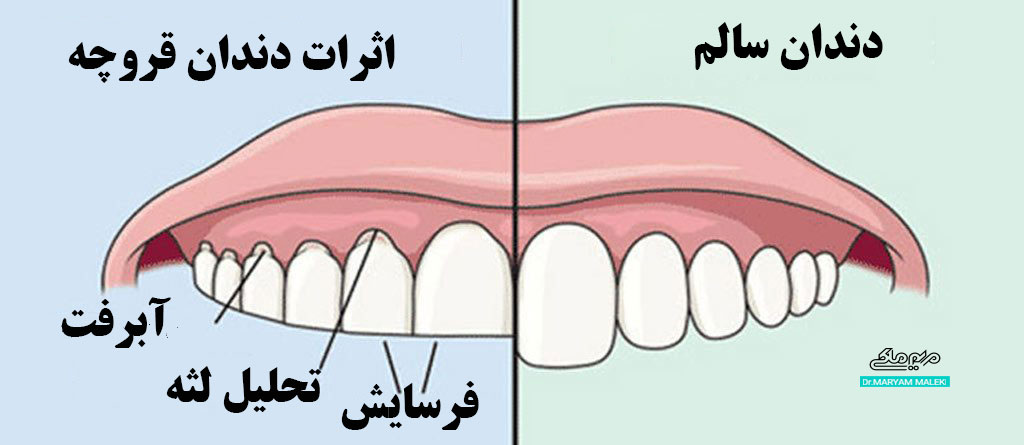 تفاوت-دندان-سالم-و-دندان-قروچه