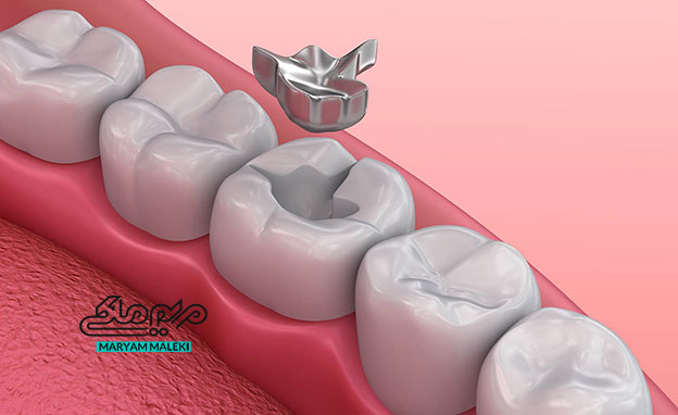 مشکلات پوستی پرکردنی-آمالگام