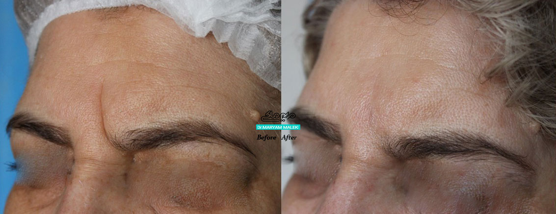 تزریق فیلر بوتاکس در خط اخم