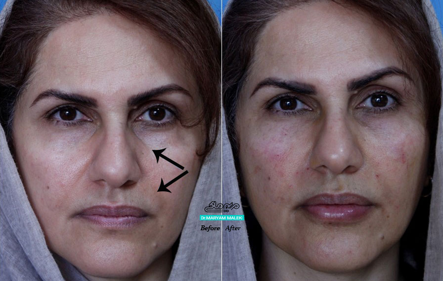 بلافاصله بعد از تزریق فیلر در زیر چشم، سرگونه، خط خنده و لب پایینی