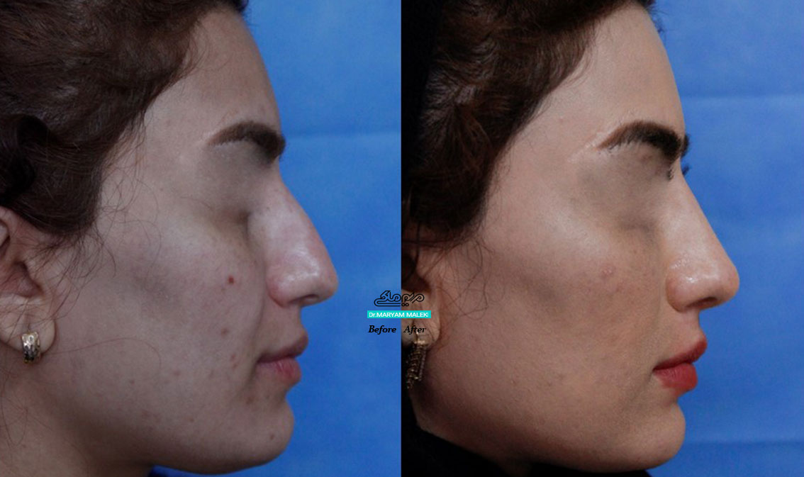 تزریق فیلر در بینی، زیر چشم و سرگونه جهت بهبود تناسب و زیبایی پروفایل نیم رخ صورت