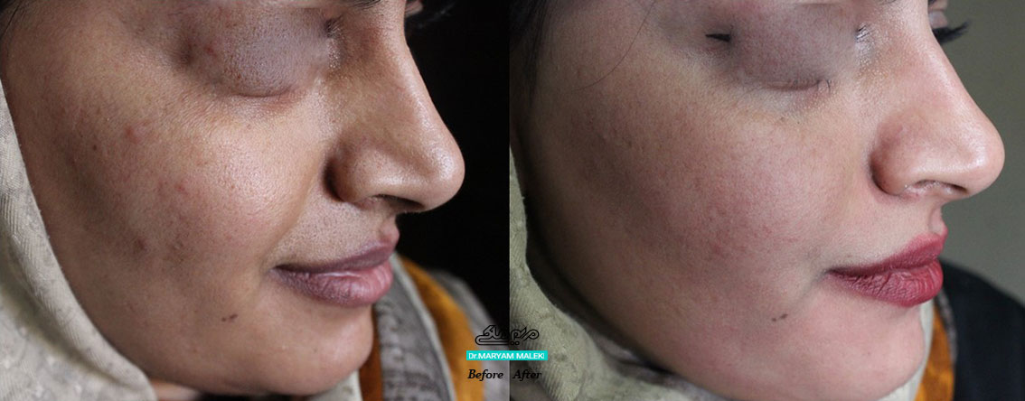 لیزر کربن پیل (کیوسویچ) جهت روشن تر کردن تیرگی پوست