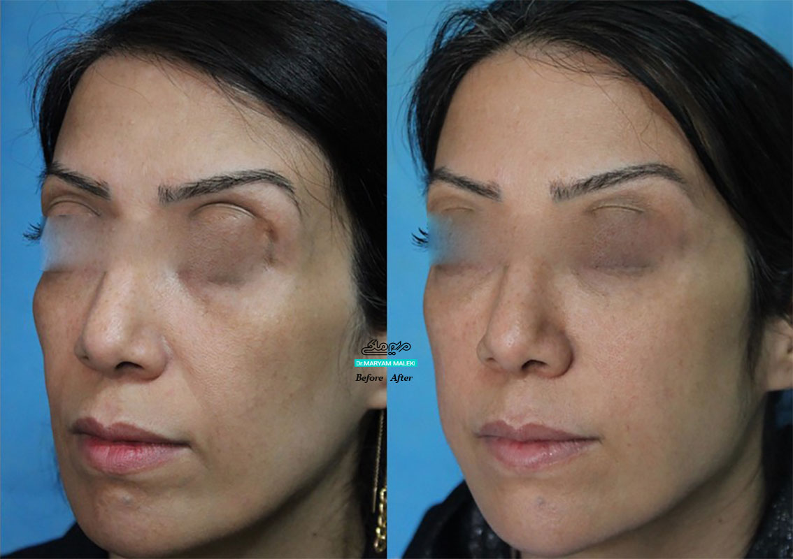 یک سال پس از تزریق ژل در نواحی شقیقه، گونه، خط خنده و پانه