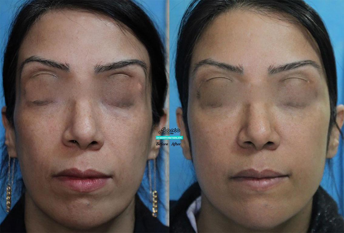 یک سال پس از تزریق ژل در نواحی شقیقه، گونه، خط خنده و چانه