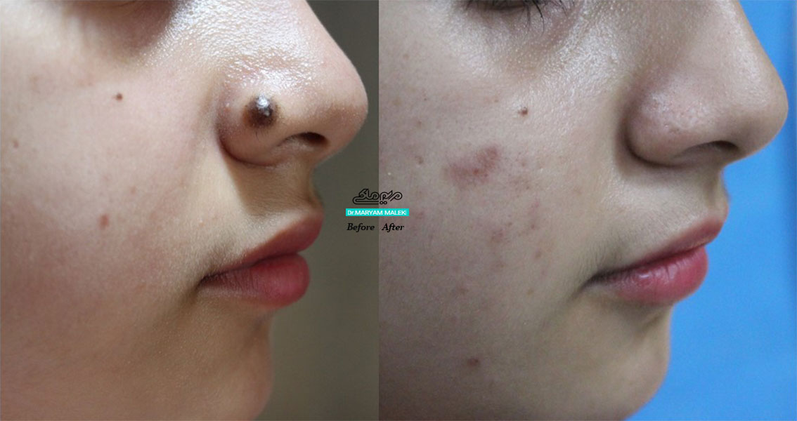 برداشتن خال عمیق مادرزادی روی بینی بدون جراحی یا برش