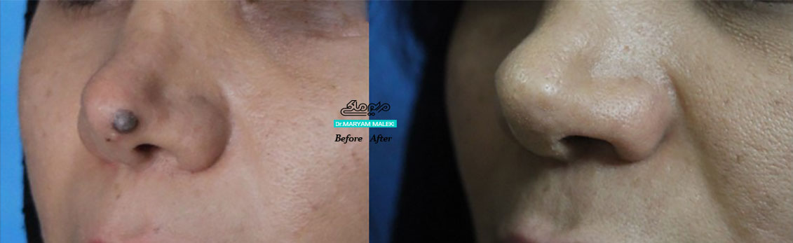 لیزر خال بینی در یک جلسه بدون بخیه و بدون بازگشت، در این عکس که پس از گذشت چند ماه گرفته شده مختصری گودی جای خال دیده می شود که با ترمیم کاملا صاف می شود.
