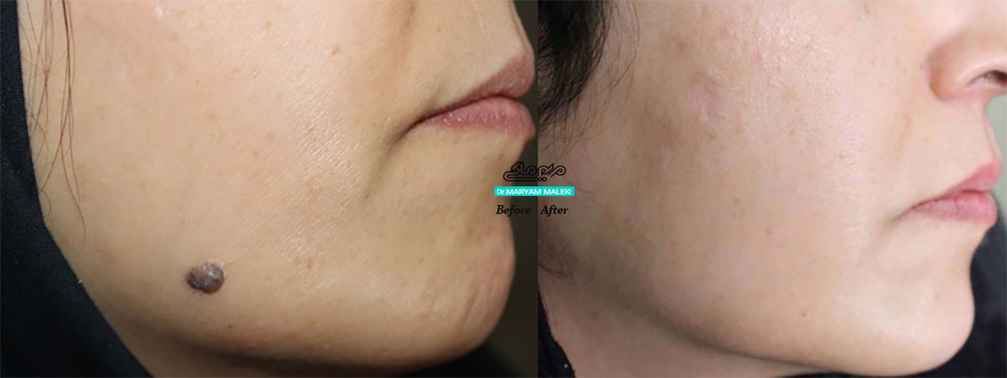 برداشتن خال با لیزر بدون جراحی و بخیه در یک جلسه بدون گذاشتن کمترین اثر و بدون بازگشت