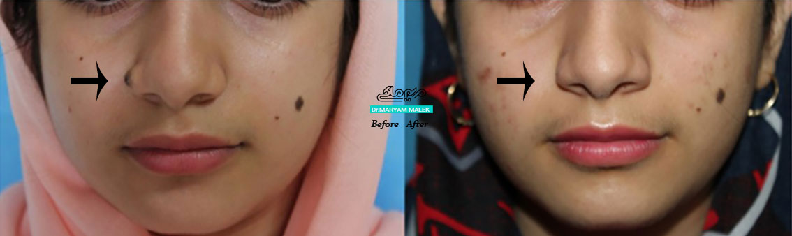 برداشتن خال بدون جراحی در اصفهان