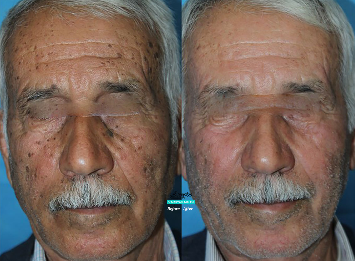 برداشتن تمام ضایعات روی صورت با لیزر در یک جلسه بدون بخیه، اسکار با بازگشت