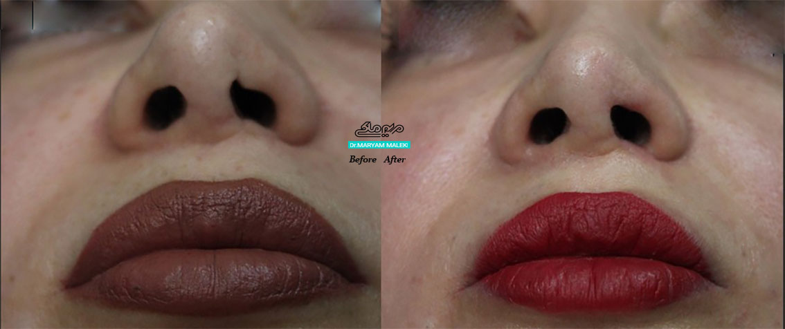 اصلاح غیرقرینگی و اسکار روی سوراخ بینی با لیزر در اصفهان