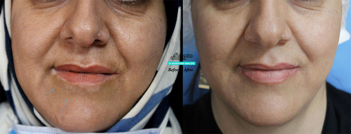 درمان ویتلیگو دور دهان با 5 جلسه لیزر اگزایمر