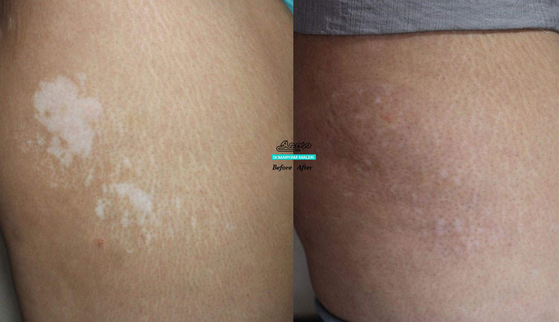 درمان نسبی ویتلیگو ران با لیزر ترکیبی بعد از دو ماه
